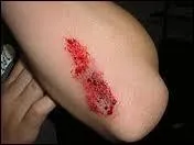 Quels sont les composants du sang qui lui permettent de s'arrter de couler en cas de blessure ?