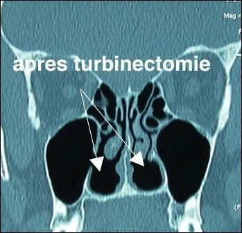 Qu'est-ce que le syndrome du nez vide ?