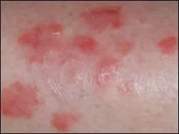 Comment doit-on crire le nom de cette maladie si on en croit les Immortels ?