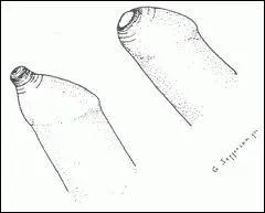 Il arrive que le prpuce soit trop troit, on parle alors de ...