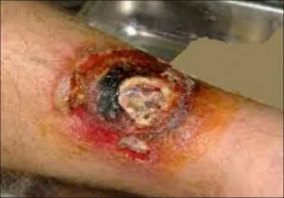 Cette trs vilaine blessure au tibia a-t-elle t cause par une autre espce de bombardier (un carabe d'Afrique du Nord appel anthia sexmaculata) ?