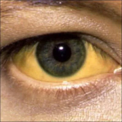 Trouvez l'antonyme du participe  rdig . Son anagramme conduit  une accumulation de bilirubine.