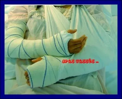 Bras cass est une autre appellation du coup franc au rugby :