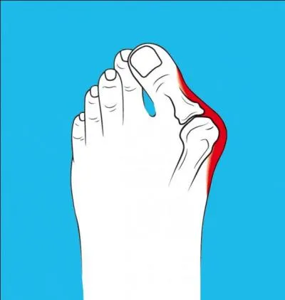 Quel est le terme plus scientifique pour nommer ce que l'on appelle un  oignon  au gros orteil ?