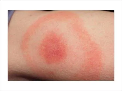 Quel genre d'insecte transmet la maladie de Lyme ?