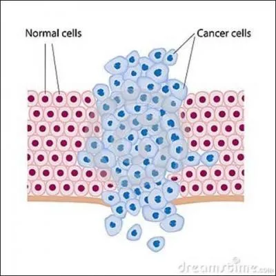 La masse cellulaire devenant importante, on parle de tumeur. Qu'est-ce que cela peut bien vouloir dire ?