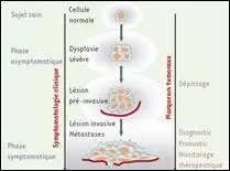Il existe plusieurs types de cancer. Quel est l'intrus ?