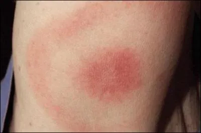 Quel genre d'insecte transmet la maladie de Lyme ?