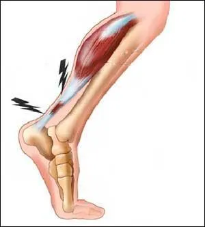 Le tendon d'Achille se trouve dans le mollet.