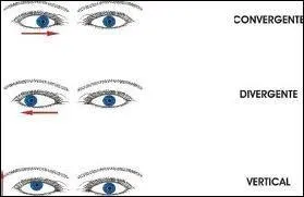 Une personne qui  louche  est atteinte d'un dfaut visuel appel :