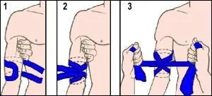 Dans quelle situation l'usage du garrot est-il le plus judicieux quand aucune autre mthode n'est possible et qu'on sait le poser ?