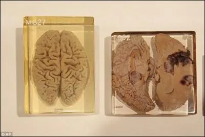 Qu'ont-ils pu observer dans l'hmisphre gauche ?