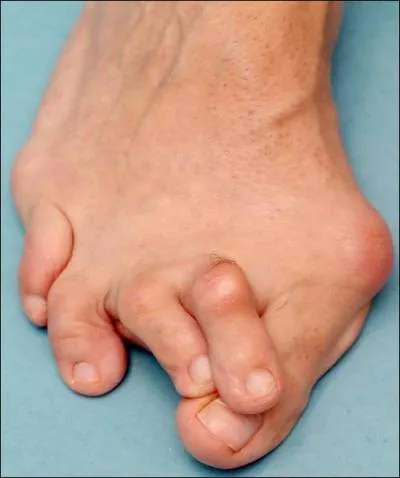 Qu'est-ce qu'un hallux valgus (oignon) ?