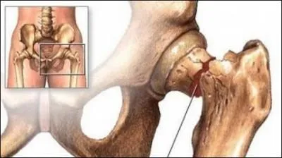 La rarfaction du tissu osseux observe chez les sujets gs et plus particulirement chez les femmes est ...