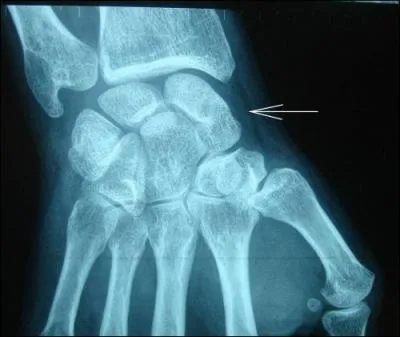 O est situ l'os scaphode ?