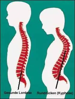 Lorsque la colonne vertbrale forme un creux important au niveau des lombaires, cela s'appelle une ...