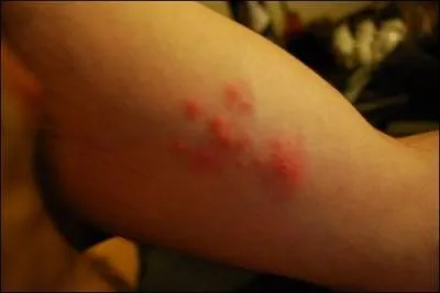 Ces ... sur la peau du bras peuvent tre dues  une allergie.