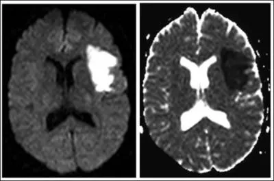 Lorsqu'un accident vasculaire crbral est d  l'obstruction d'un vaisseau, on dit qu'il s'agit d'un accident ...