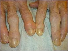 L'arthrose touche beaucoup de personnes et peut tre trs invalidante. Le gouvernement parle de drembourser prochainement l'un des traitements de l'arthrose, lequel ?