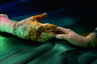 Le professeur Mimoun est trs connu, il est chef de service  l'hpital Saint Louis  paris, quelle est sa spcialit ?