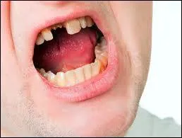 Il n'y a qu'une dent sur la mchoire  Jean. Quel est le pluriel de  dent  en anglais ?