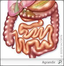 Quelle complication peut provoquer une crise ''d'appendicite'' ?