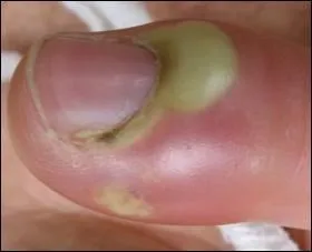 Quel est l'autre nom par lequel on dsigne un panaris ?