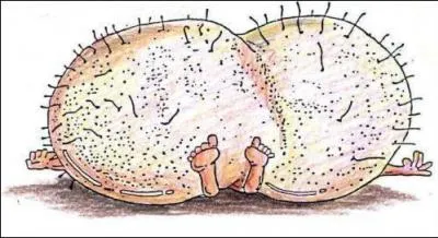 Voici une pathologie que ces messieurs n'apprcient pas du tout, c'est l'orchite qui se manifeste par ...