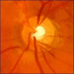 Le glaucome qui rend aveugle si on ne le soigne pas  temps atteint ...