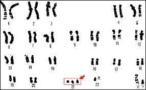 L'anomalie principale de la transmission de chromosome est l'anomalie de son nombre que l'on appelle aneuplodie . La plus connue d'entre elles est la trisomie 21. Quelle est son mcanisme le plus frquent ?