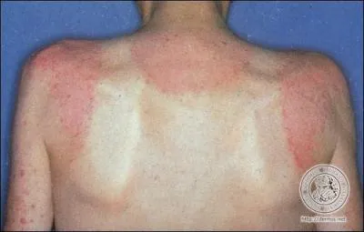 Lsion de la peau due  l'action des rayons solaires :