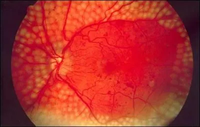 Par quelle maladie, la rtinopathie peut-elle tre provoque ?