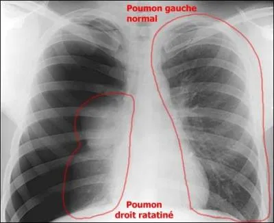 Comment appelle-t-on ce phnomne par lequel le poumon se dcolle de la plvre ?