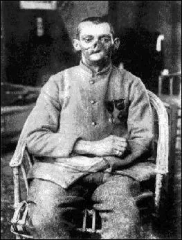 La France a perdu 1,4 million de soldats, 300 000 civils et dénombre près de 4,2 millions de poilus blessés. Pour certains d'entre eux, les gueules cassées, la guerre n'est pas finie en 1918, la guerre se lit toujours sur les visages. Ils sont...
