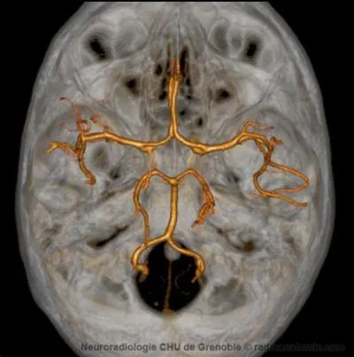 Qu'est-ce qui prsente un renflement en forme d'ampoule ?