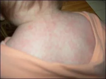 Quelle est cette infection virale cutanée chez l'enfant, qui se présente comme une fièvre soudaine, suivie de l'apparition d'une éruption cutanée rosâtre, sans gravité ?