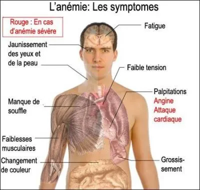 Une carence en vitamine B12 peut entraner une anmie. L'anmie se manifeste par une chute du nombre de globules rouges mais aussi...
