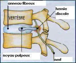 Je termine par une perle mdicale : Madame se plaint bruyamment de la hausse de ses impts, en plus dit-elle :  Mon mari a une hernie... .  Terminez sa phrase avec humour.