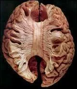 Le cerveau est composé de 2 hémisphères (droit et gauche) qui sont connectés par ...