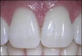 Comment s'appellent les 8 dents de devant ?