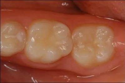 A quoi servent les molaires ?