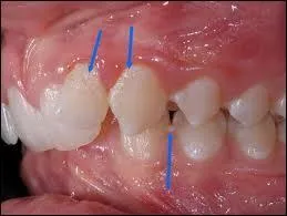 Qu'est-ce que la plaque dentaire ?