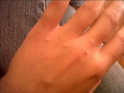 Quelle est cette maladie infectieuse de la peau, contagieuse, mais bénigne, causée par un parasite acarien nommé sarcopte ?