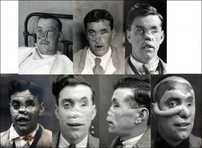 Qu'appelle-t-on "les gueules cassées" ? Attention, la photo ci-contre peut choquer.