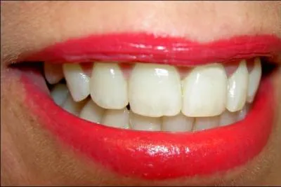 Un jeune indien s'est fait enlevé 232 dents.