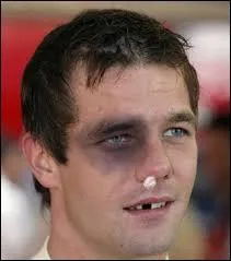 Qu'est-ce qu'une ecchymose ?