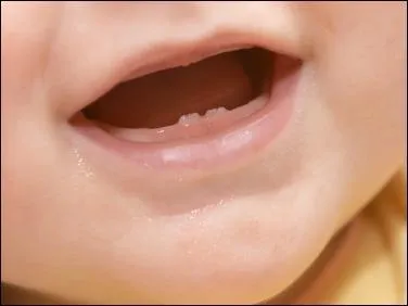 La plupart des bébés naissent sans ... . Parmi les exceptions il y aurait Louis XIV, Napoléon et Hannibal.