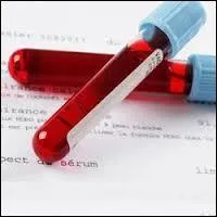 Le bilan préopératoire avant chirurgie cardiaque doit être assez complet. Il comporte habituellement, selon le protocole des services :