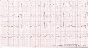 Définir le terme "ECG"