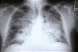 Que signifie l'abréviation "OAP" ?